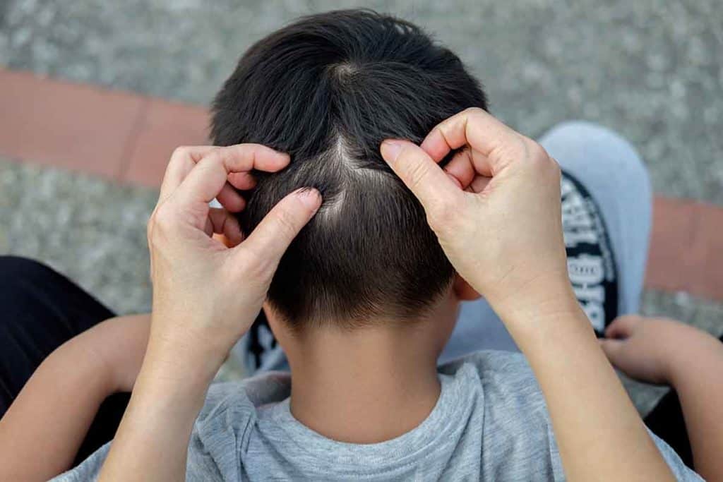 Head Lice on Kids' Head